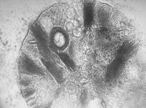 M,27y. | sea-blue histiocyte syndrome M,27y. | sea-blue histiocyte syndrome